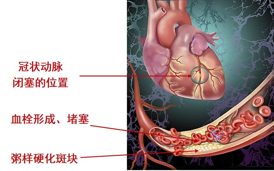 心肌梗死.jpg