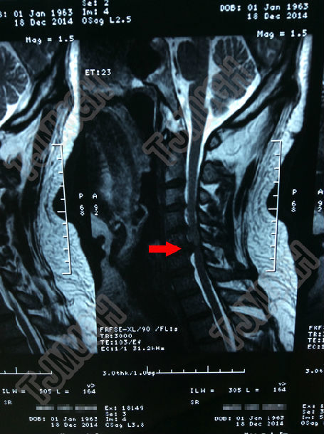 颈椎椎管狭窄1例