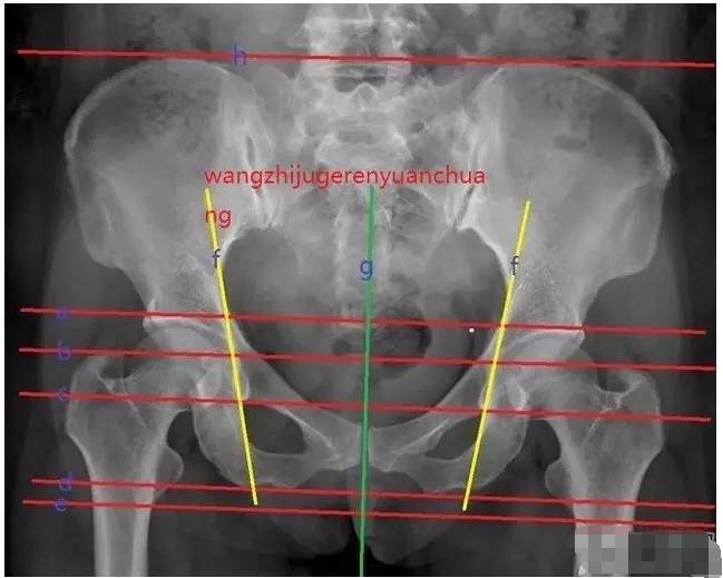 据说只有1骨科医生能读懂骨盆x线不信你来试