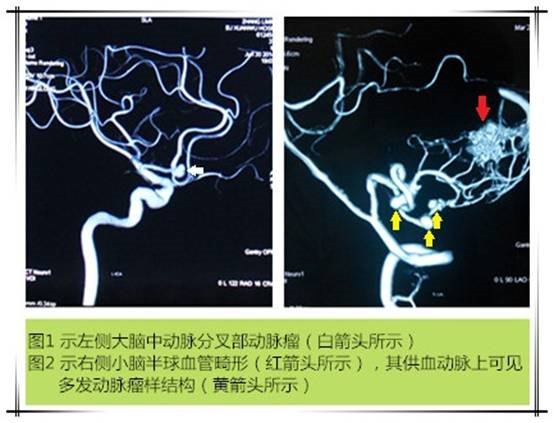 首都医科大学宣武医院神经外科李桂林 在脑血管畸形中,动静脉畸形约占