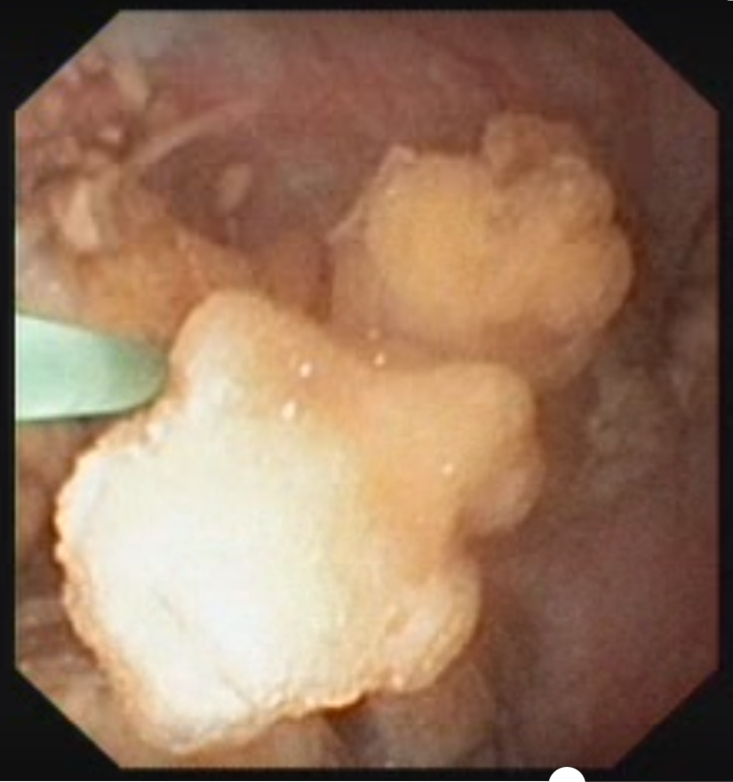 电子输尿管软镜下可见左肾下盏多发结石