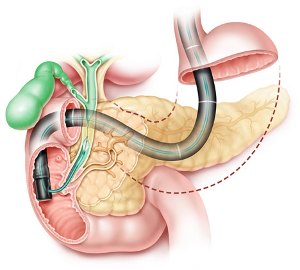 胰腺囊肿