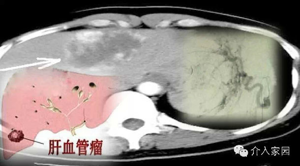 肝血管瘤，你还在开刀治疗吗？