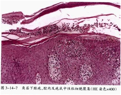 五,苔藓样念珠状疹 1037