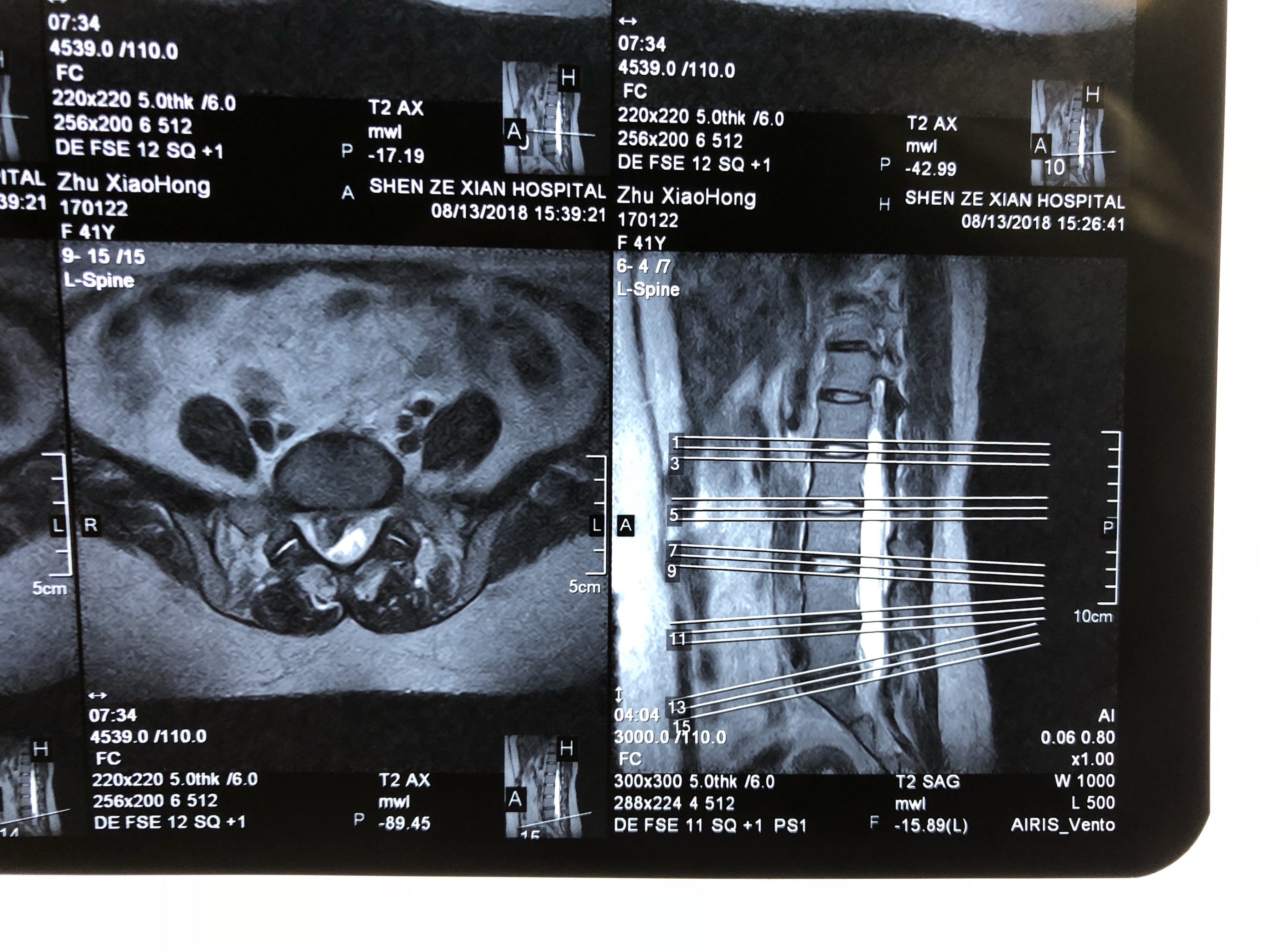 腰椎间盘突出微创治疗术中症状消失