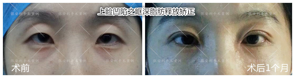 上睑凹陷眶深脂肪释放矫正