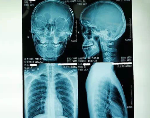 严重的面纵裂患者改造术案列