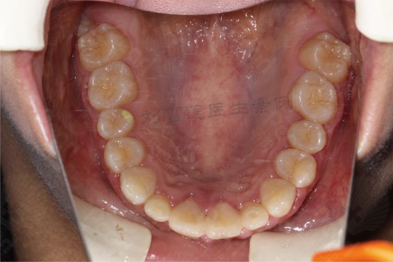 矫正后:口内上颌牙齿,上颌牙齿排列整齐.