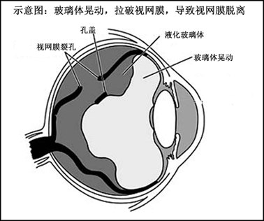 玻璃体牵拉示意图.bmp