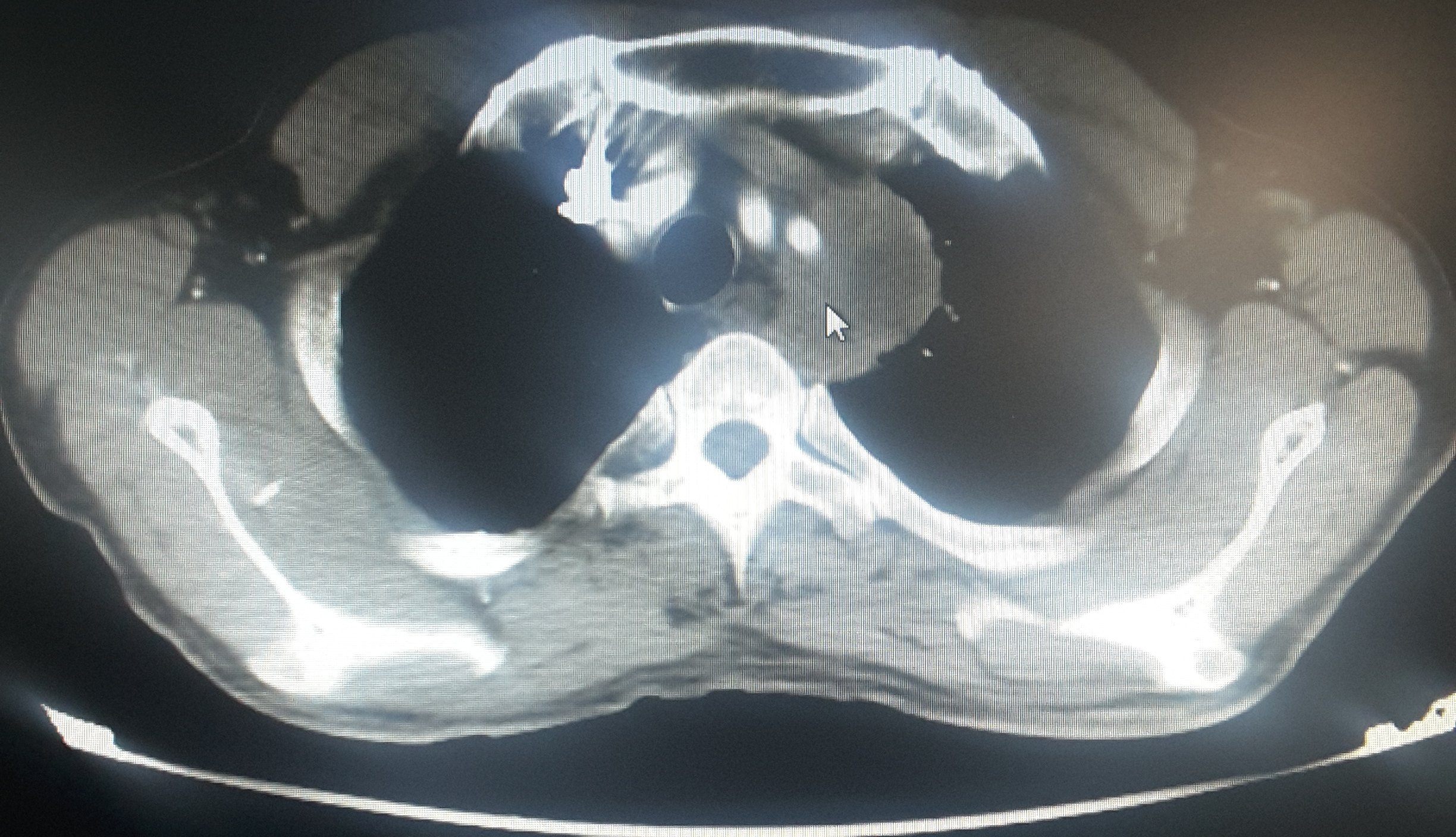 刘懿博士说肺癌(五八五)肺肿瘤包绕重要动脉高