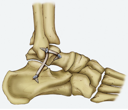 习惯性扭脚,到底是怎么一回事?