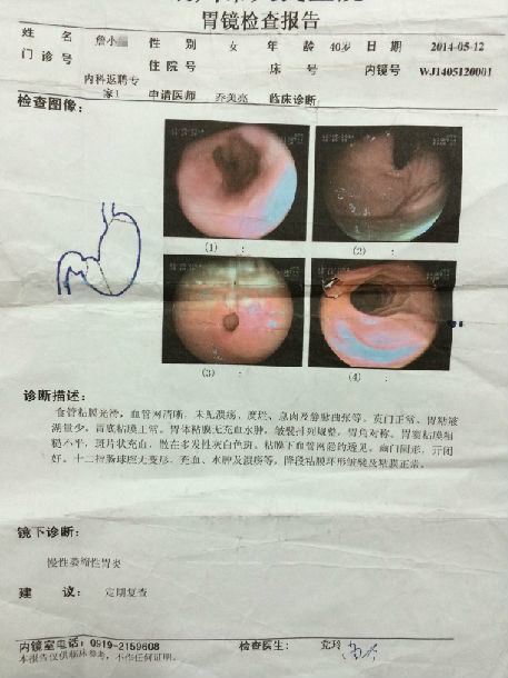 患者10:陈**   疗前胃镜为"胃窦部多发浅溃疡,慢性萎缩性 胃炎 "