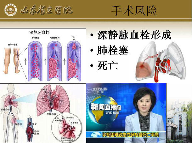 山东省立医院 朱化强 胆囊切除 胆管切开取石 t型