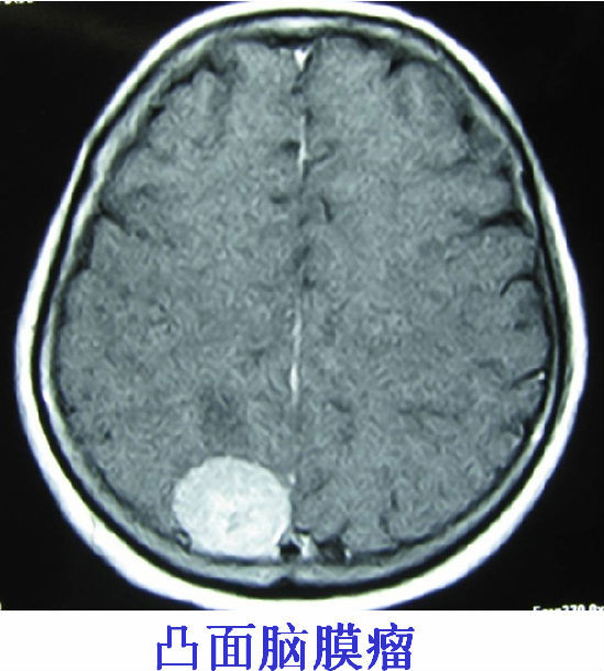 大脑凸面脑膜瘤标准化临床路径