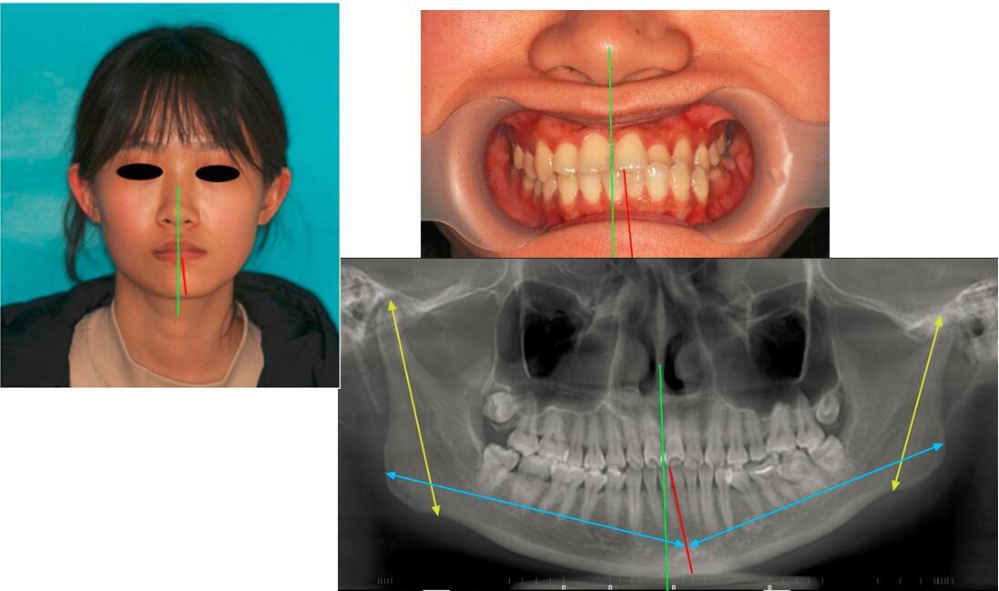 患侧上颌磨牙向下伸长,下颌角处高度不一(患侧低于健侧),髁突伸长,髁