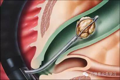 内镜微创治疗胆总管结石_胆管结石_胆管结石