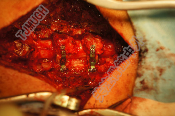 今日手术-颈椎后路减压 - 好大夫在线 ·智慧互