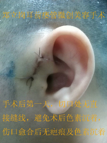 先天性耳前瘘管微创美容手术第十一回广东佛山禅城丘