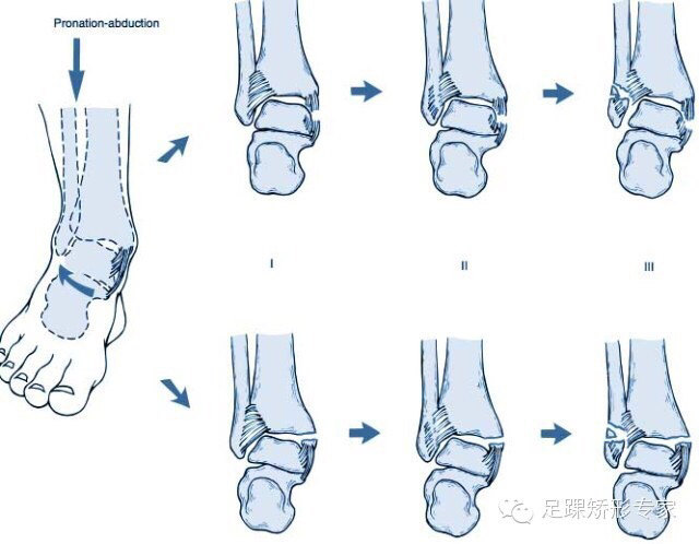 后胫腓韧带撕裂或胫骨后外侧撕脱骨折.