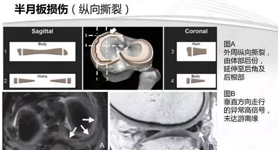 【半月板】半月板损伤的mri诊断