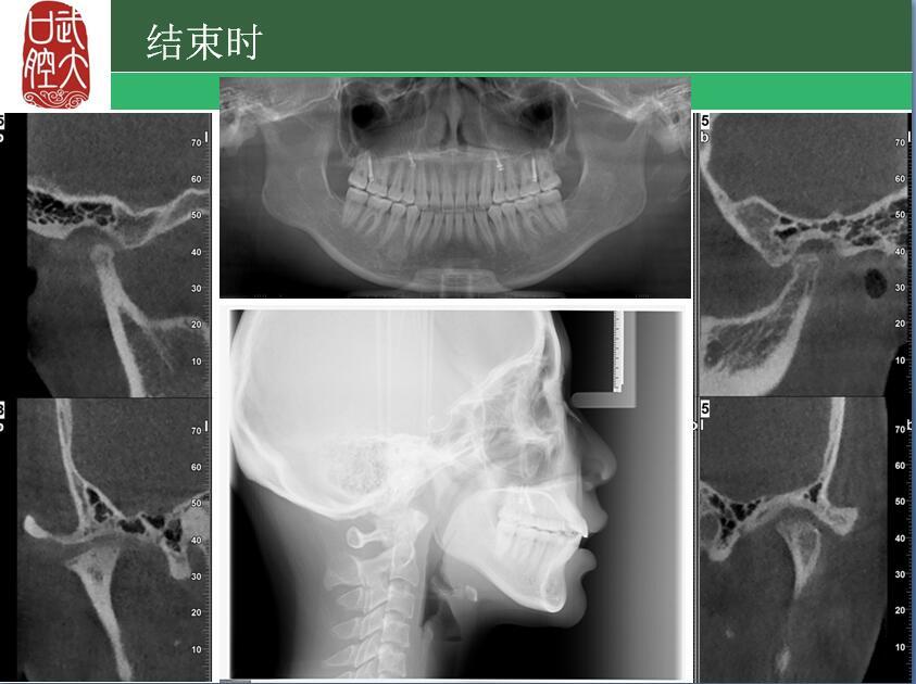 同时,很重要的一点,由于重度 骨关节病 可导致 髁突吸收变短变小