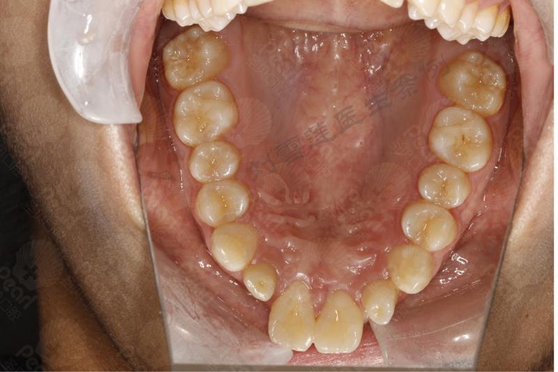 牙齿矫正病例分析牙列不齐深覆合深覆盖畸形过小牙