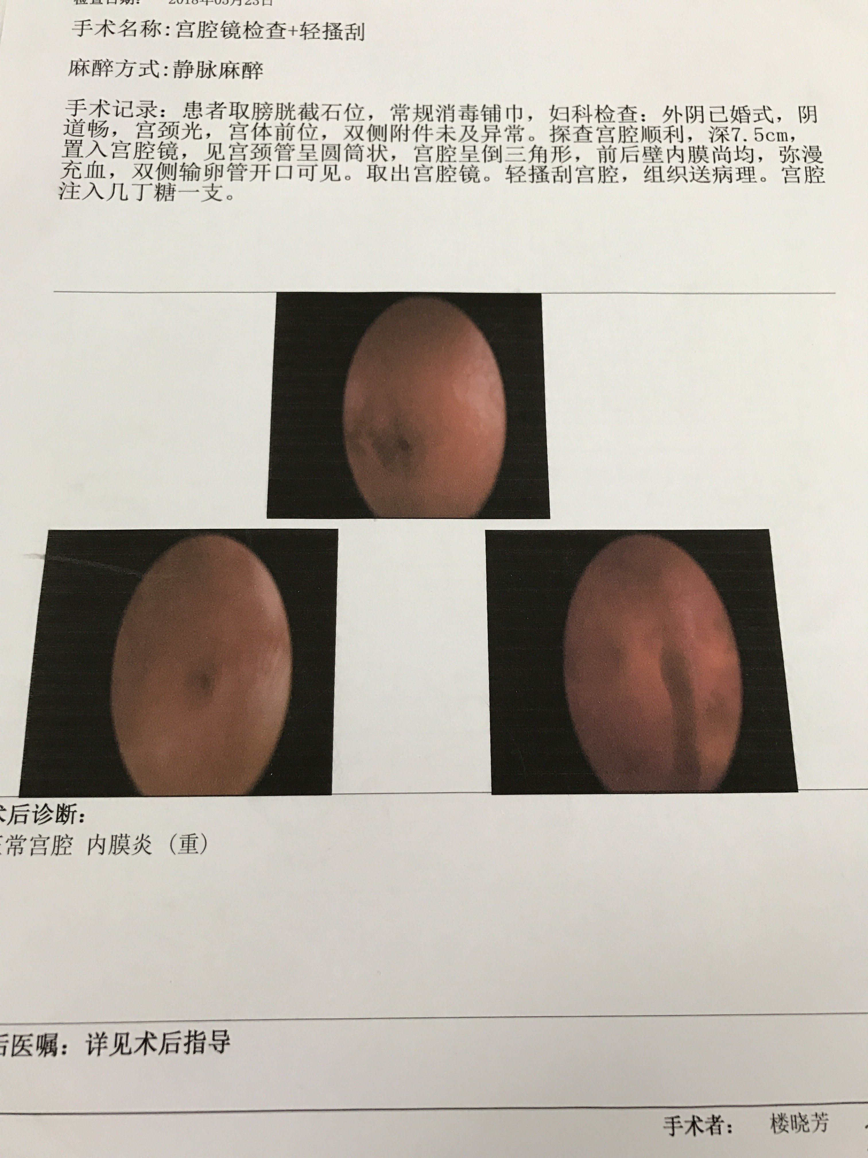 楼医生宫腔镜手术案例八