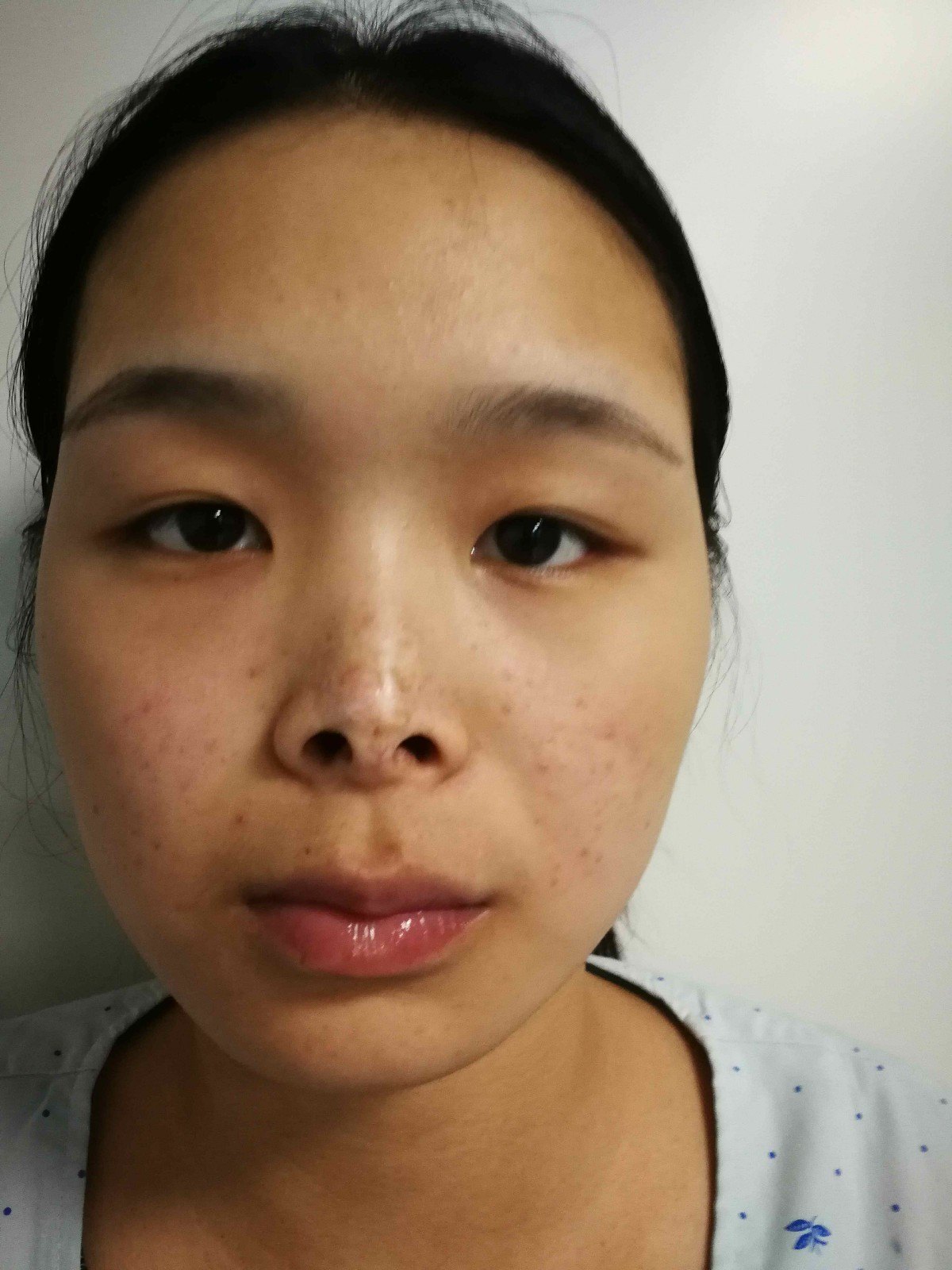 唇部血管瘤注射硬化剂后缺损鼻翼退缩,鼻尖下垂