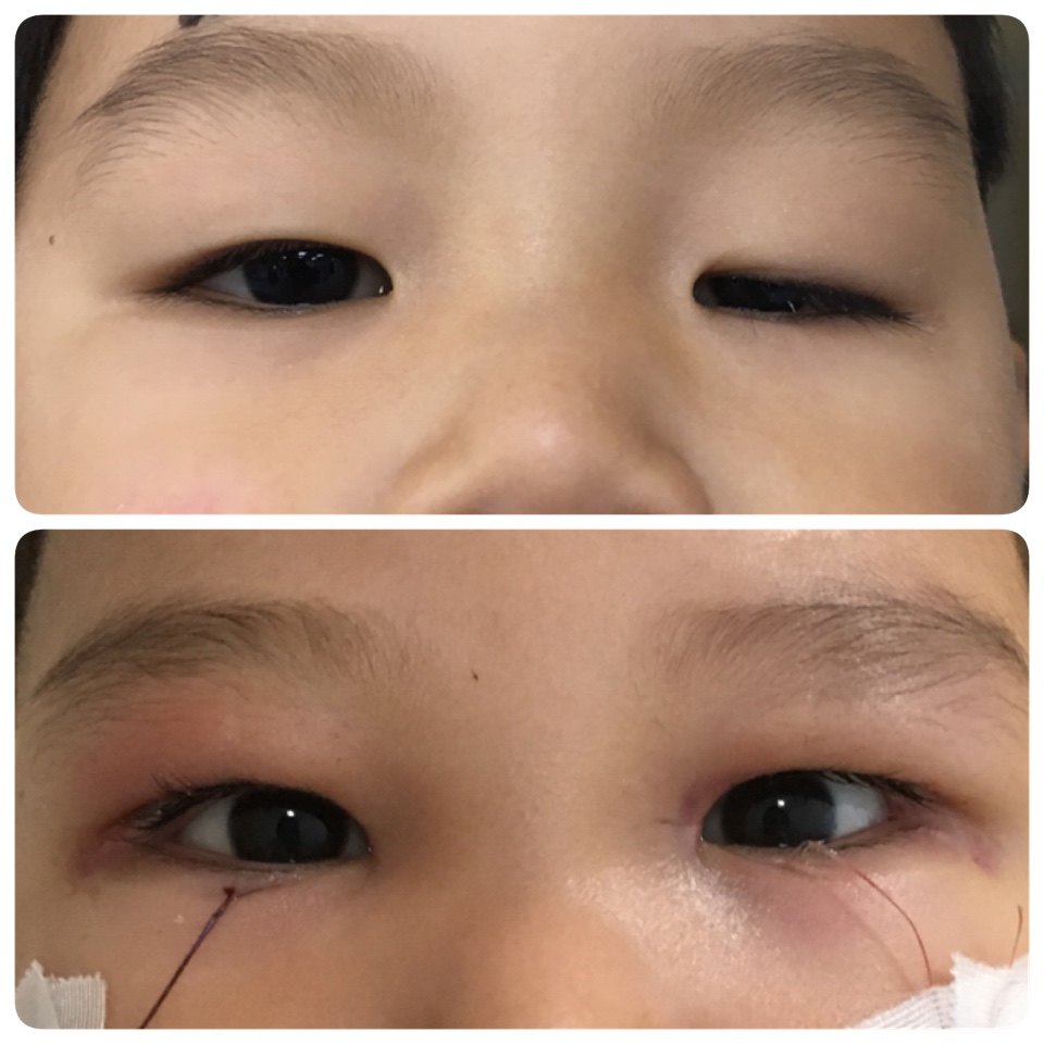 眼皮抬不起来是怎么回事——上睑下垂的小知识
