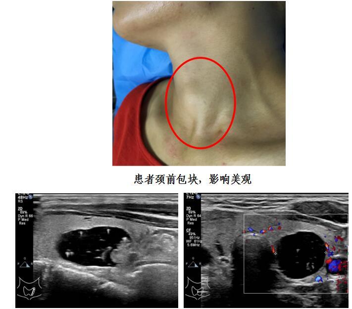 详细) 甲状腺良性结节随诊观察过程中如有下述情况需要考虑手术治疗