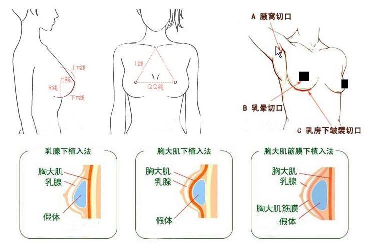 假体隆胸相关知识