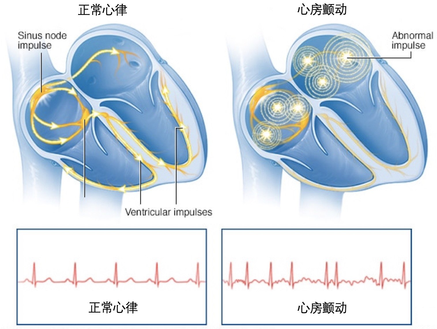 和您一起认识心房颤动什么是房颤?