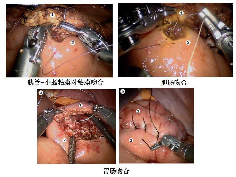 图 机器人胰十二指肠切除术中消化道重建