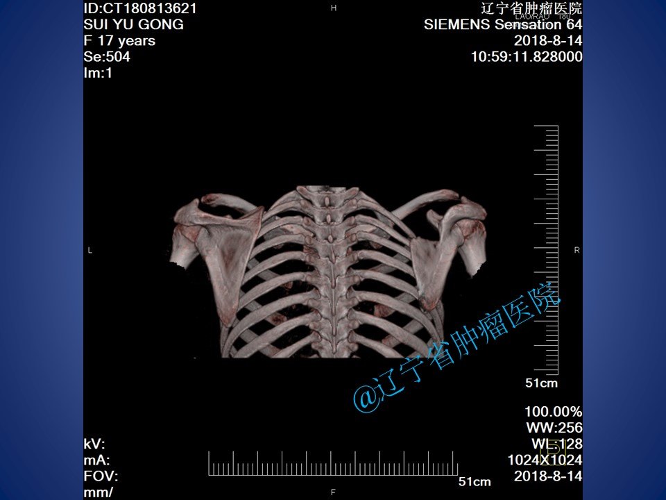 肩胛骨软骨肉瘤手术病例