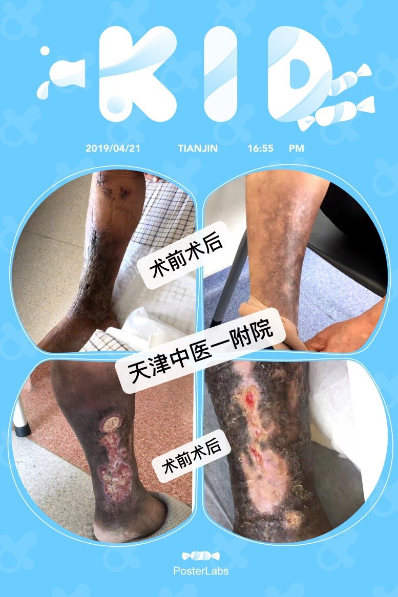 臁疮不能治是谣言