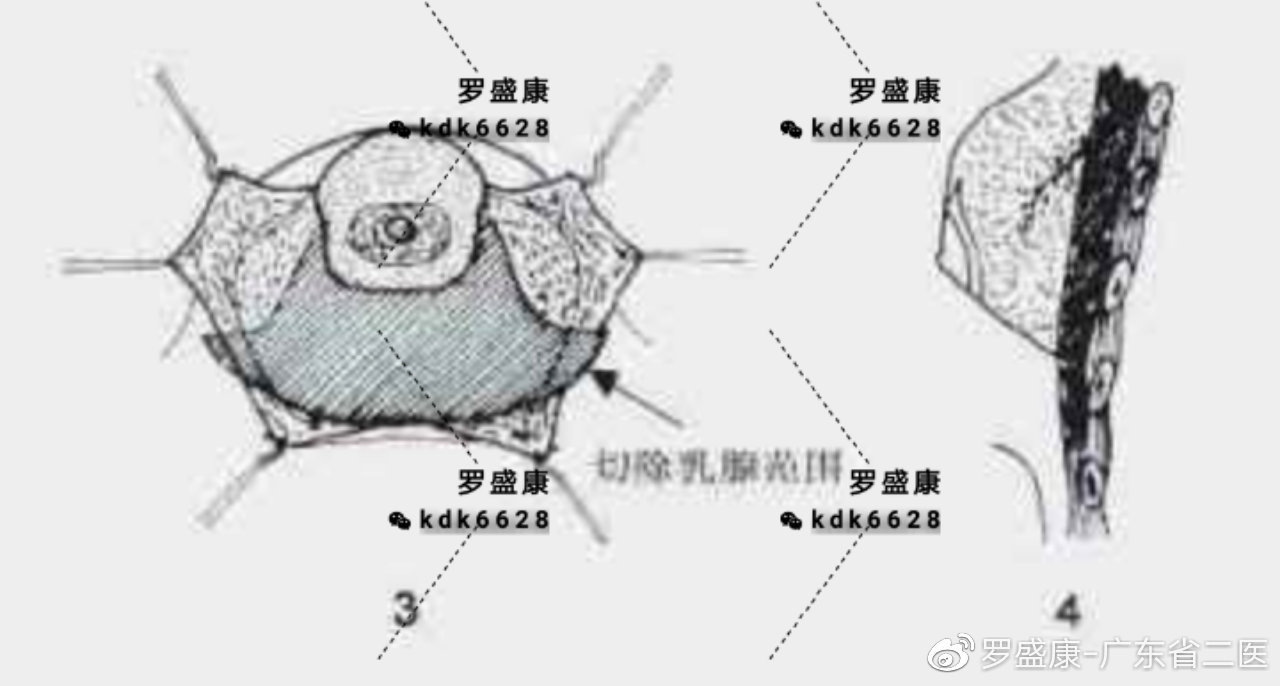乳房下垂悬吊术