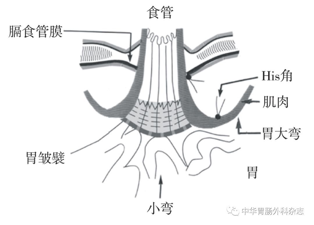 转载|食管裂孔疝修补-力求结构与功能的统一