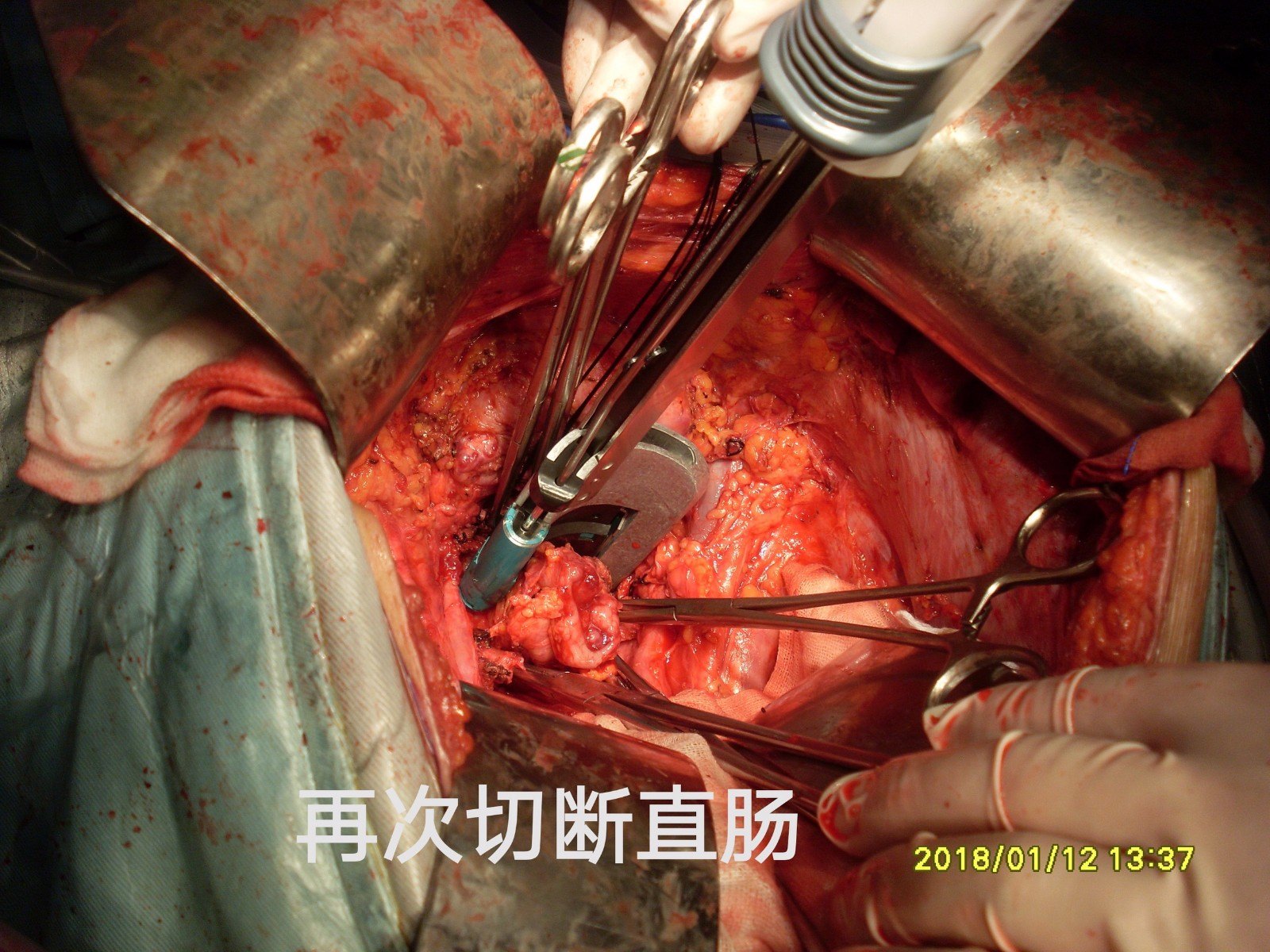 病例96Ⅲ期卵巢癌完全crshipec后18个月肠梗阻再次手术
