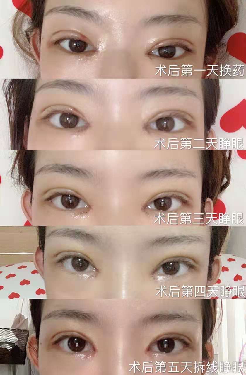 开外眼角是不是风险很大?