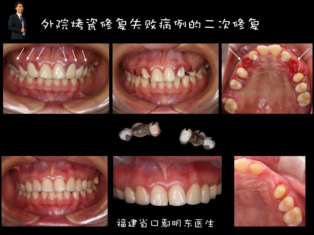 一例烤瓷修复失败病例的二次修复--福州种植牙医鄢明东 (原创)