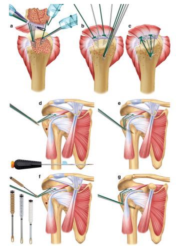 什么是肱骨近端骨折neer分型的两部分肱骨大结节移位骨折