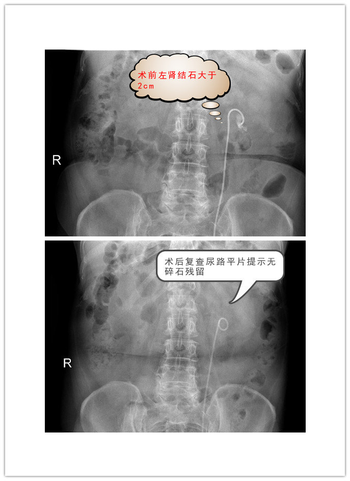 输尿管软镜碎石术治疗大于2cm肾结石