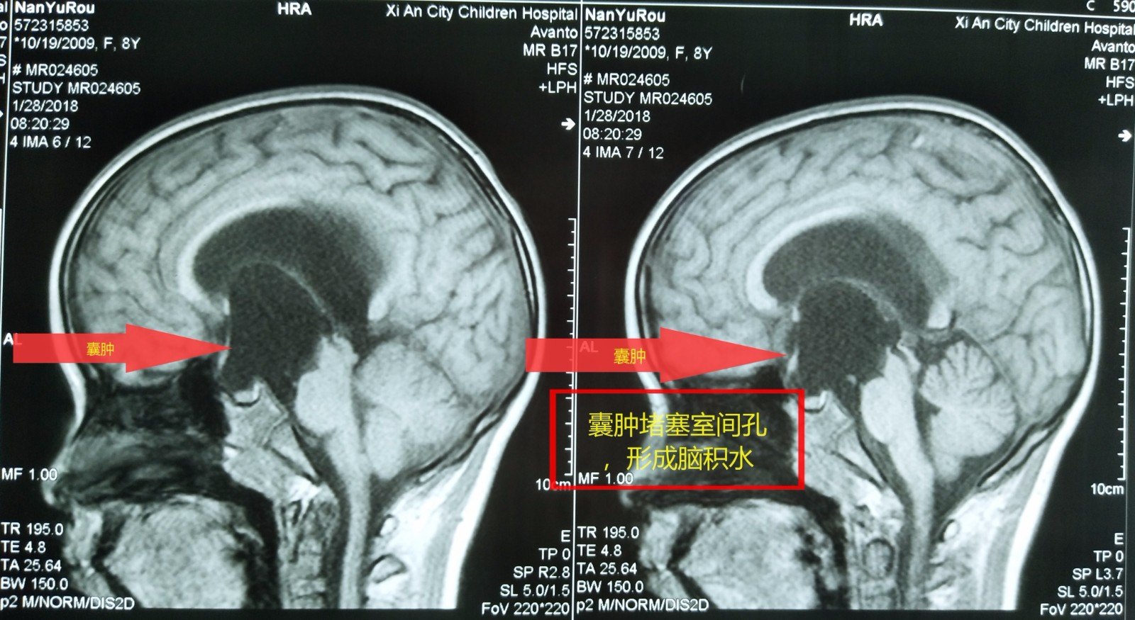 鞍上池蛛网膜囊肿的内镜治疗