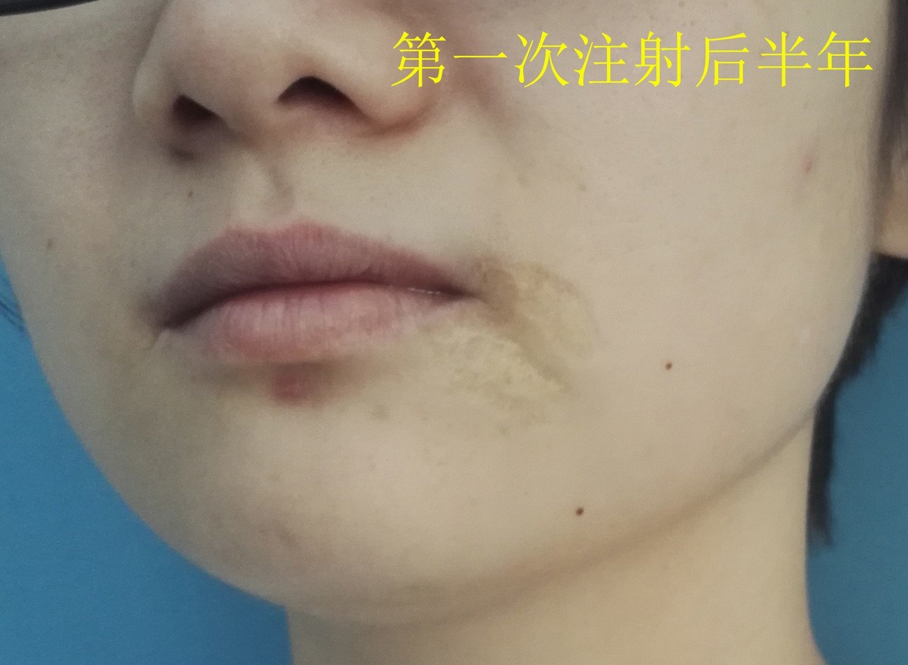 纳米脂肪脂肪胶案例治疗案例(持续更新中)_疤痕_疤痕 好大夫在线