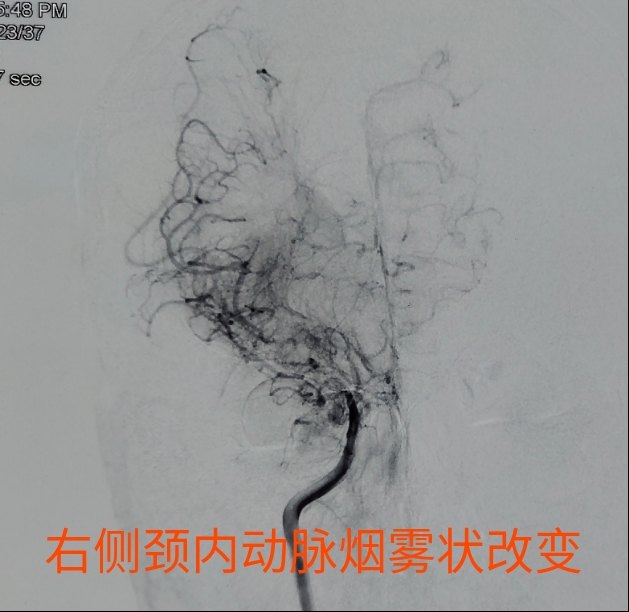 烟雾病的病人该病人男性,38岁,主因左侧肢体无力伴言语障碍2月为主要