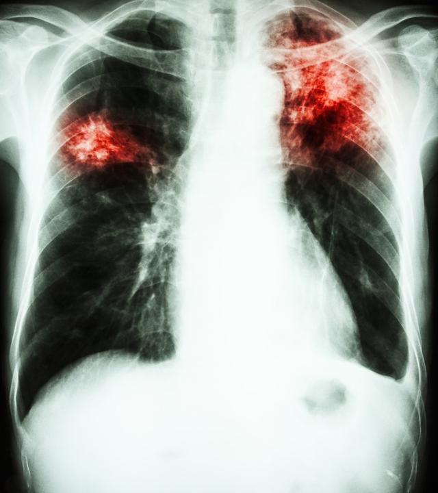 有些长的很像肺结核的肺病,一旦误诊后果严重,可能失去根治机会