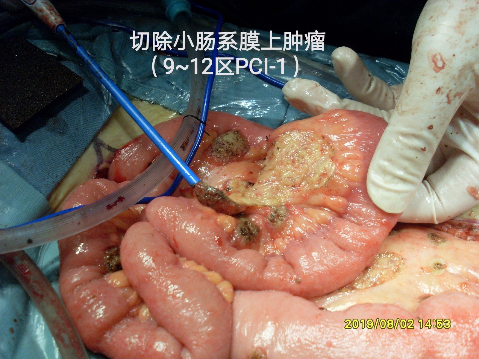 病例109--卵巢切除病理转移性黏液腺癌,7年后复发肠梗阻