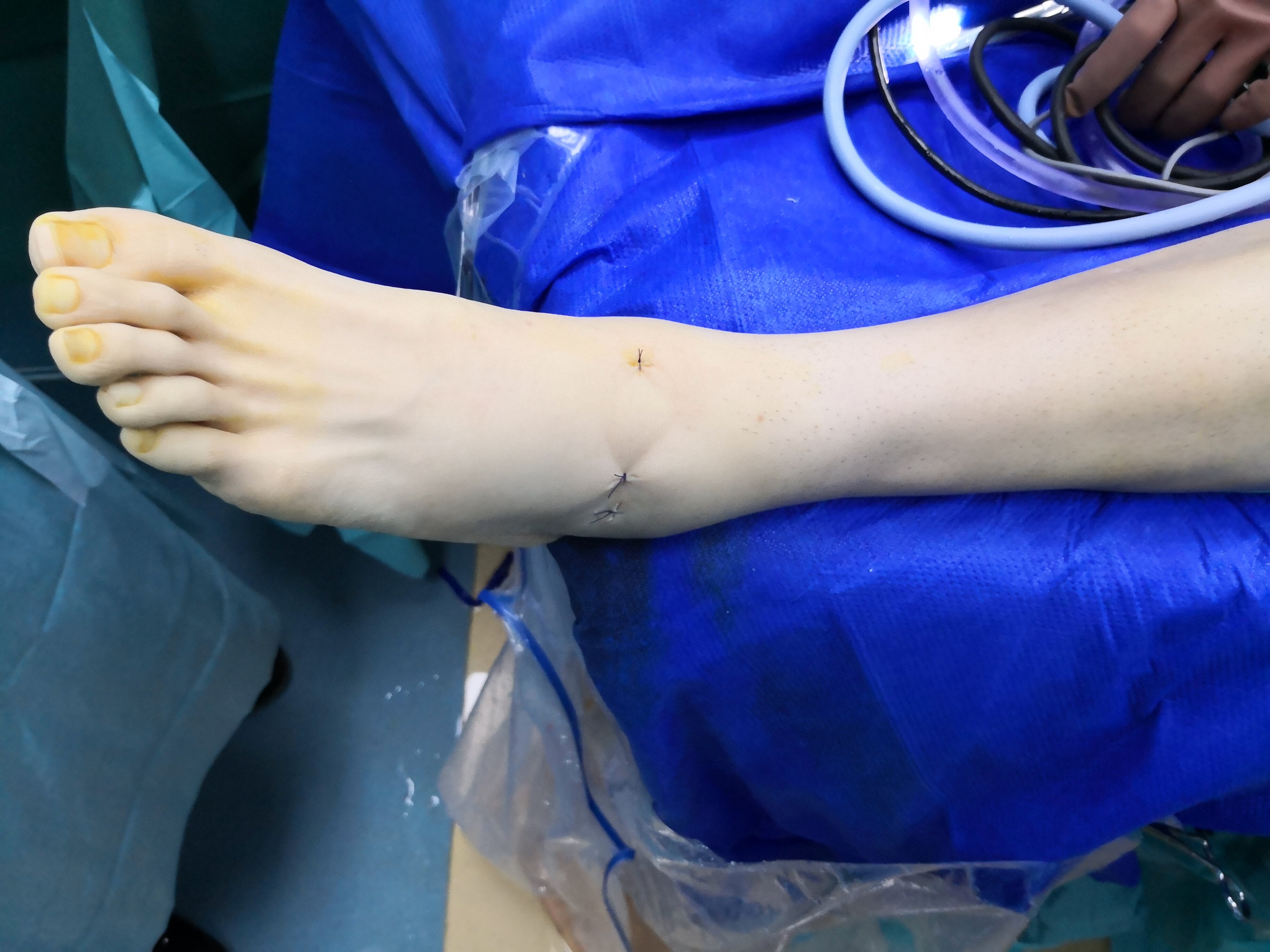 踝关节扭伤之外踝撕脱骨折的治疗