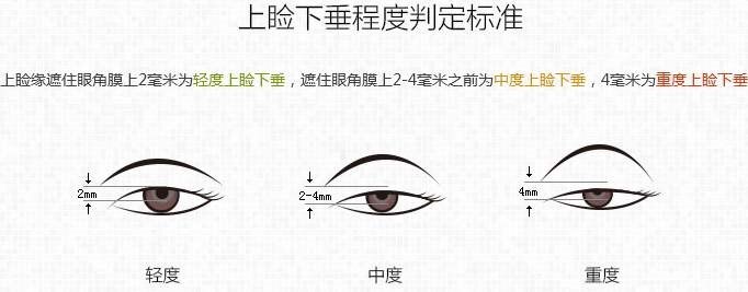 上睑下垂 是指当我们平视前方时,上眼睑的皮肤覆盖到了角膜上缘及