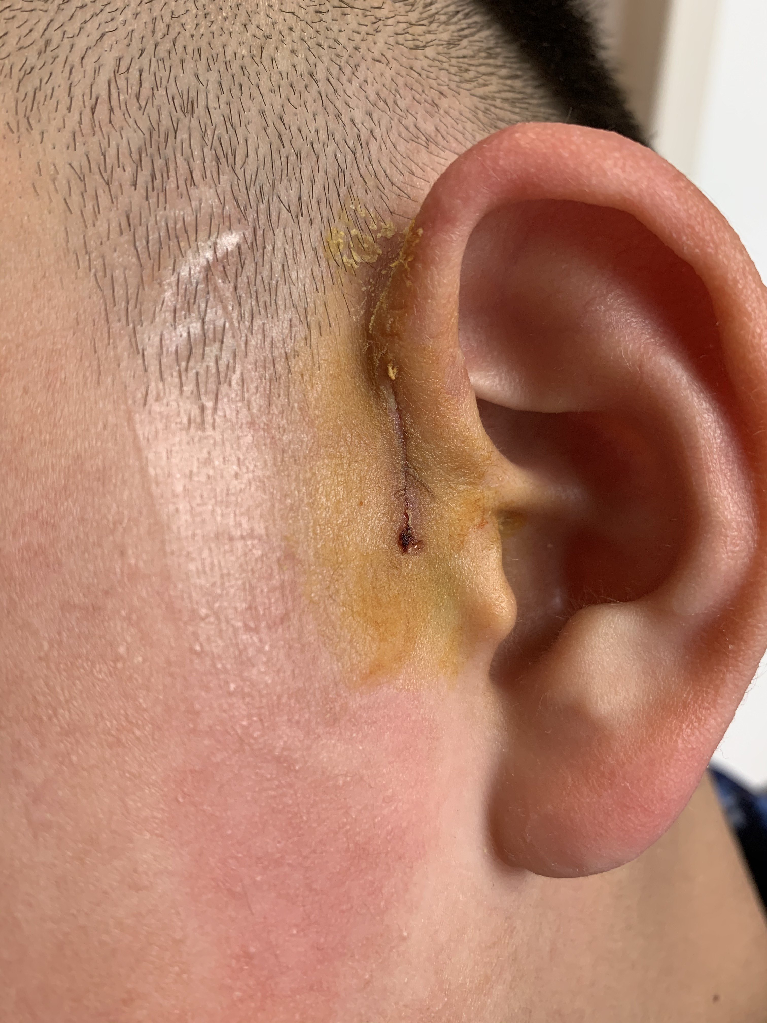 耳前瘘管微创手术及术后指南